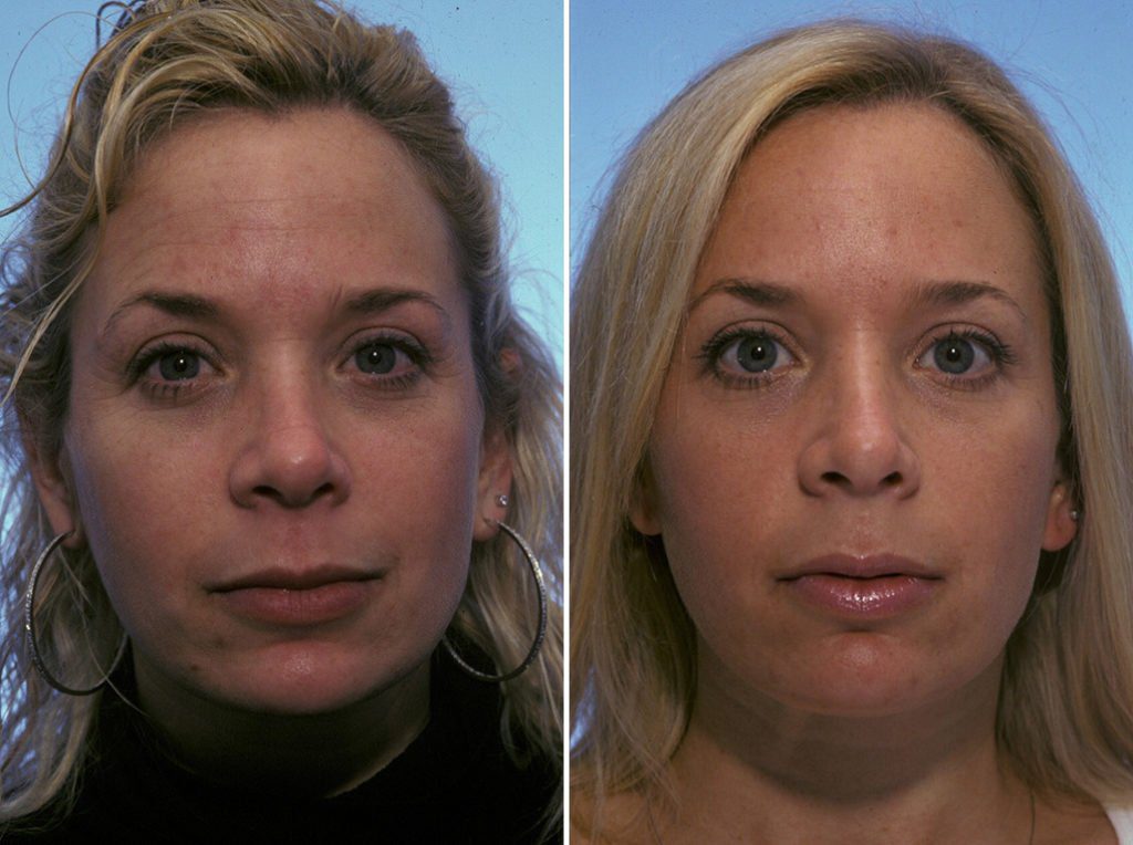 A Comprehensive Guide to Botox Before and After Eyes F N T