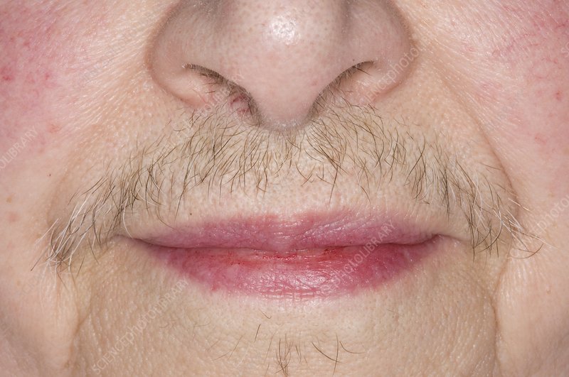 Celebs with Hirsutism